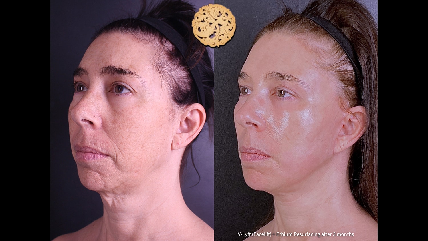 Erbium Laser Before & After