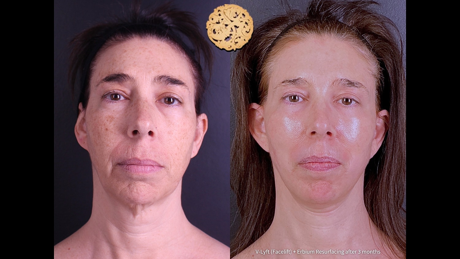 Erbium Laser Before & After