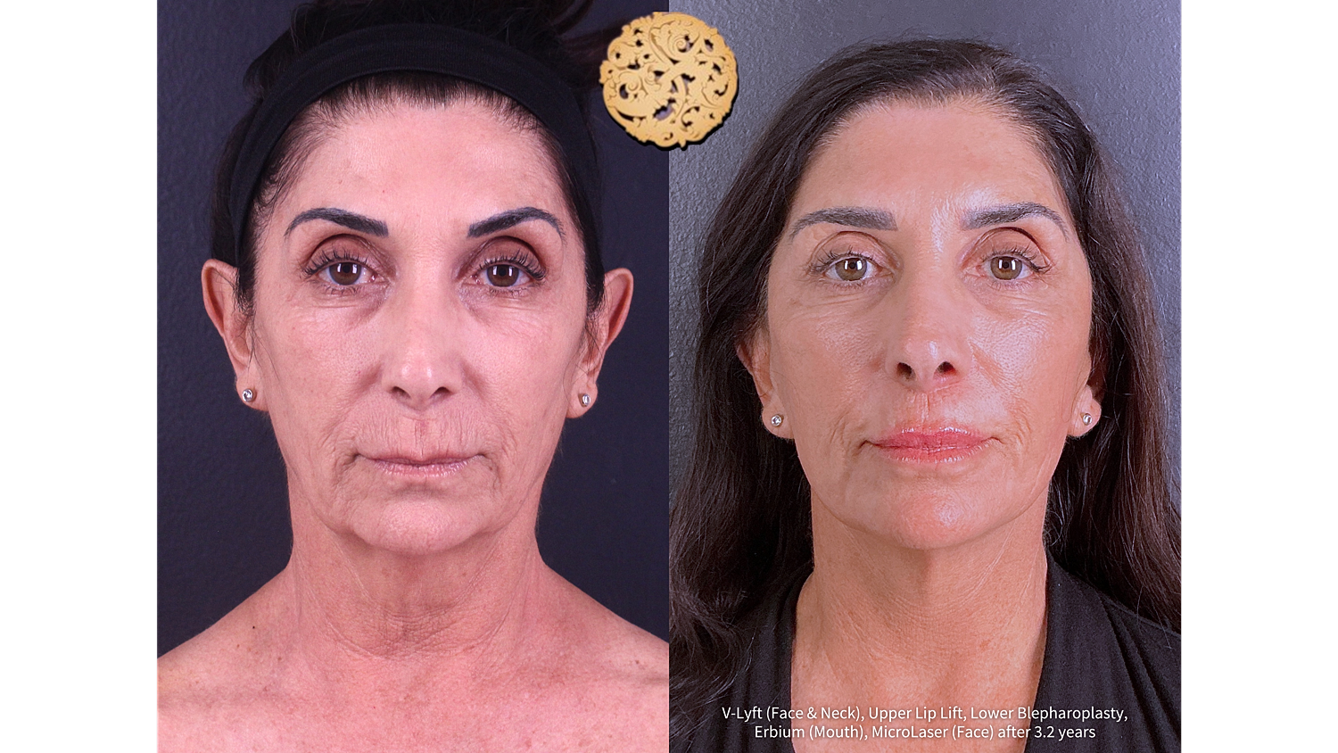Erbium (Mouth) Before and After