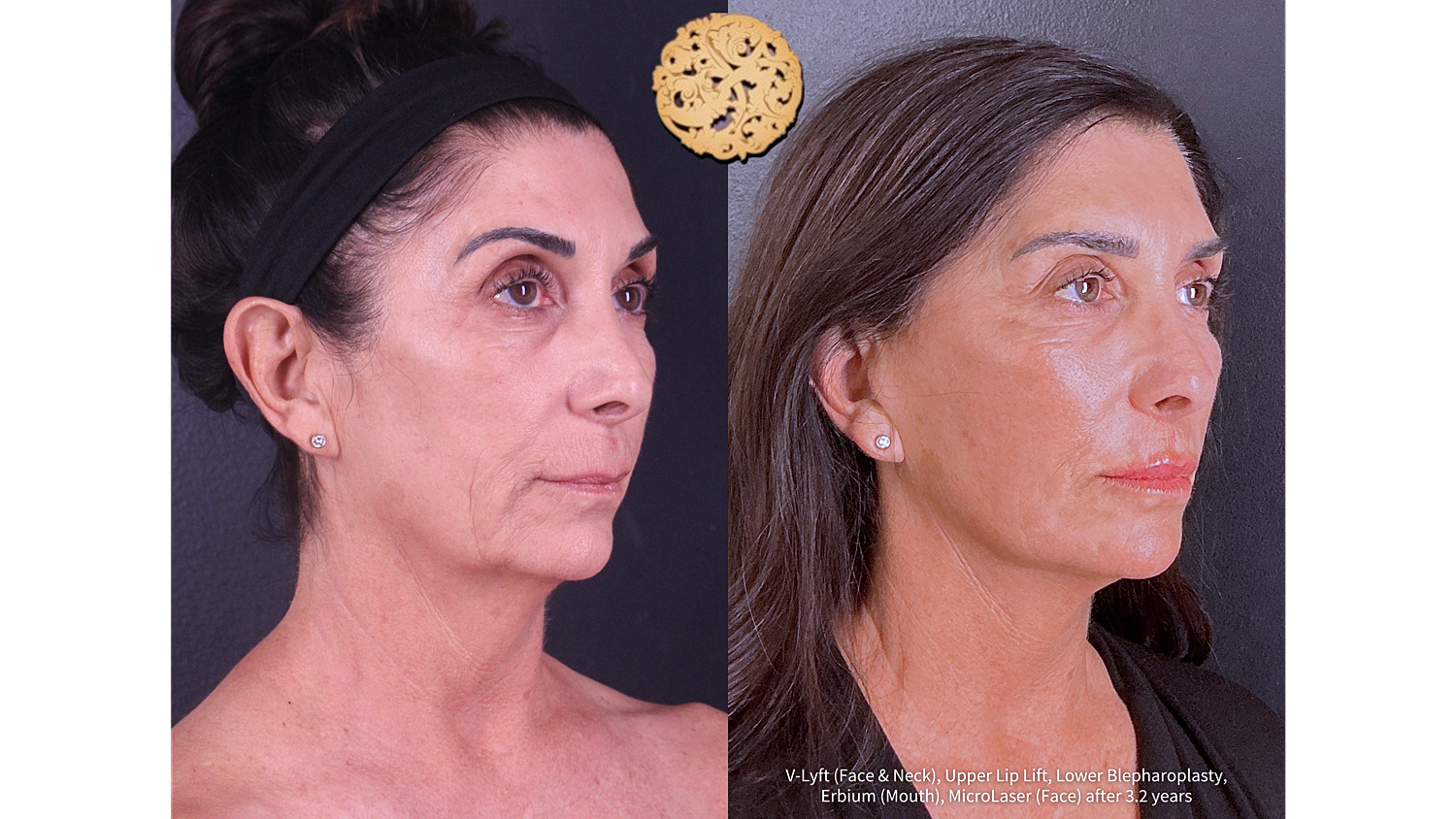 Erbium (Mouth) Before and After