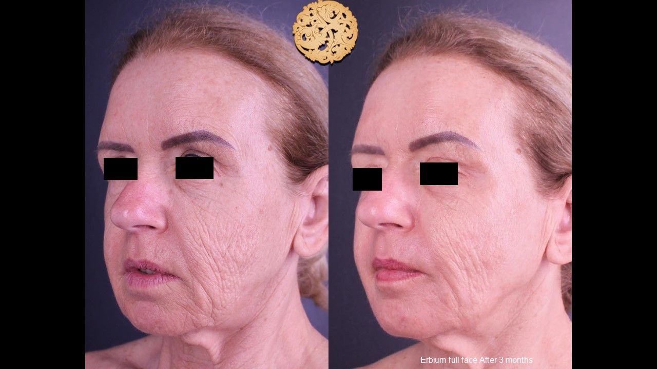 Erbium Laser Before & After