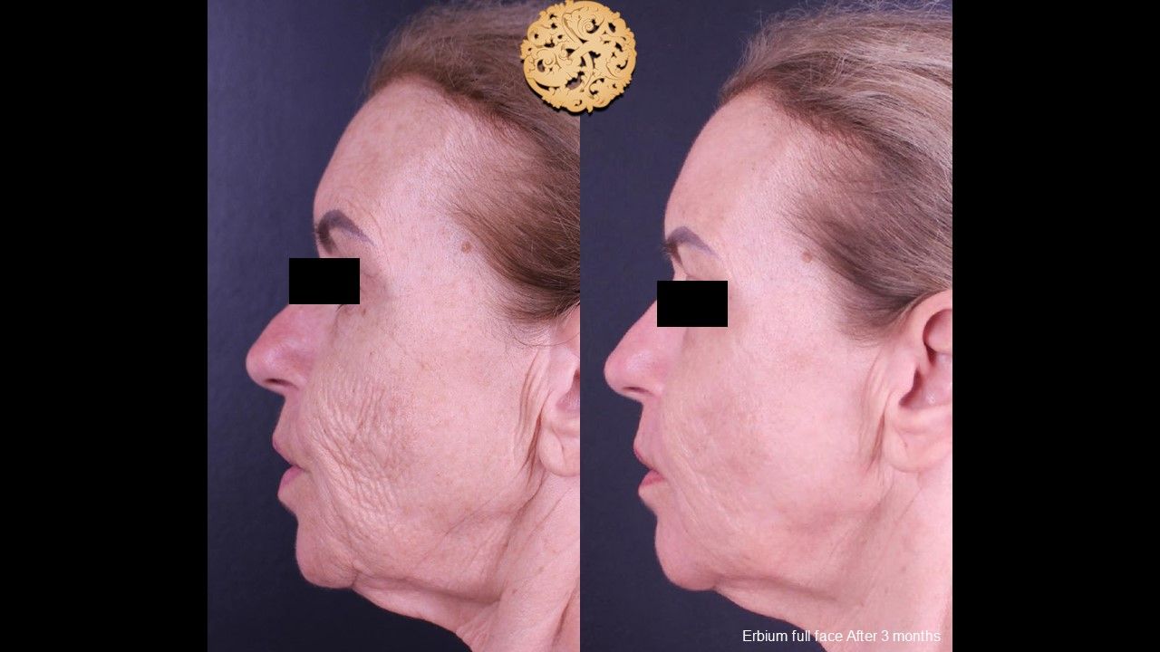 Erbium Laser Before & After