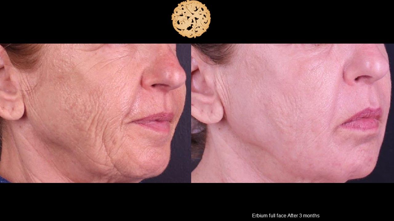 Erbium Laser Before & After