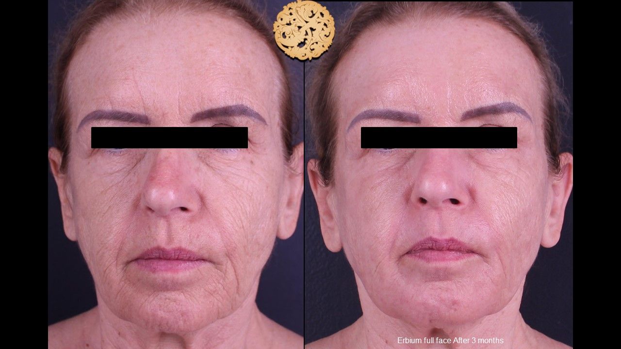 Erbium Laser Before & After