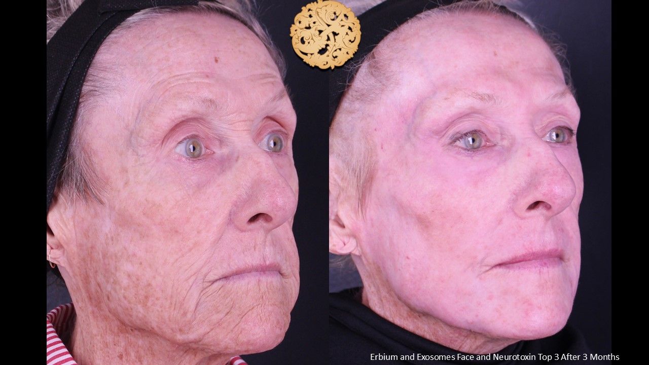 Erbium Laser Before & After