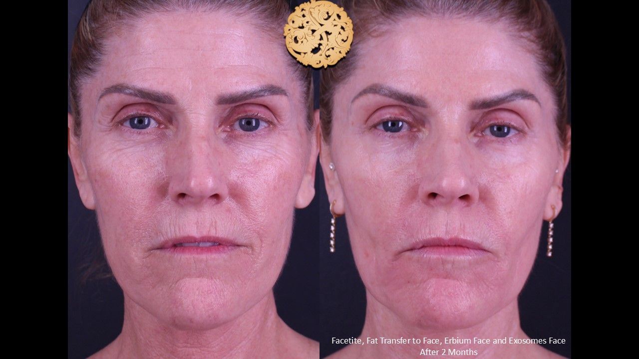 Erbium Laser Before & After