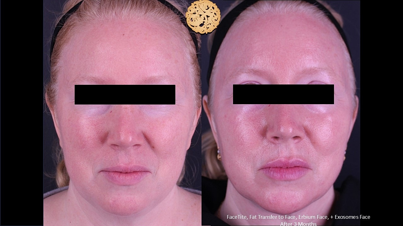 Before and after facial aesthetic treatment results.