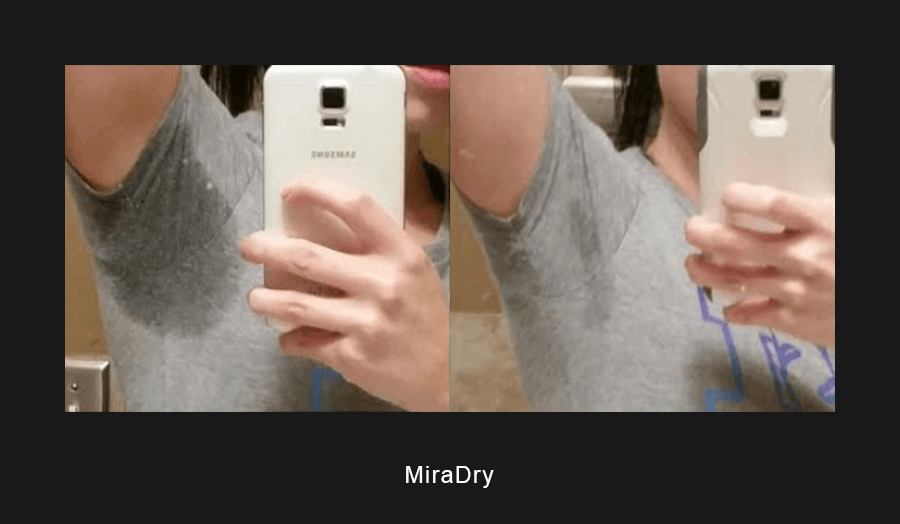 miraDry Before & After