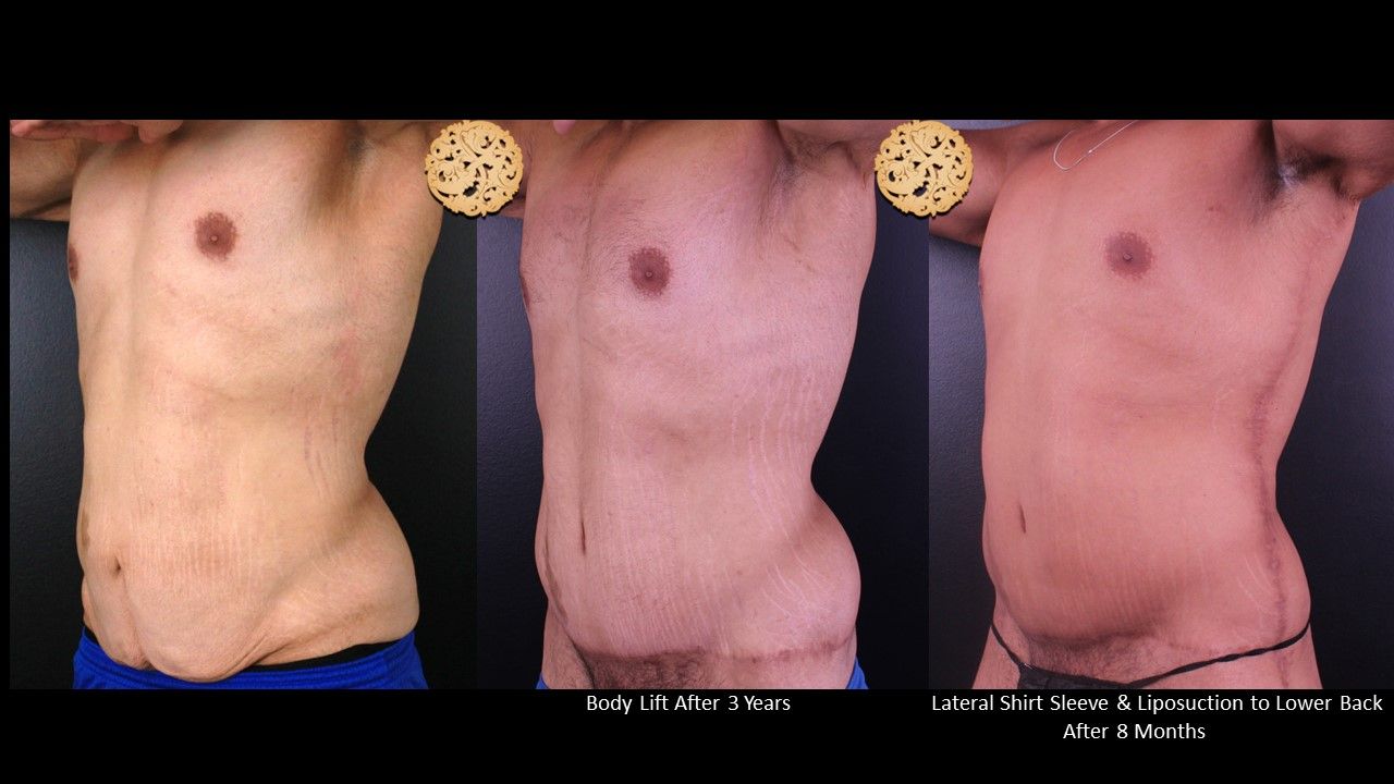 Body Lift Before & After