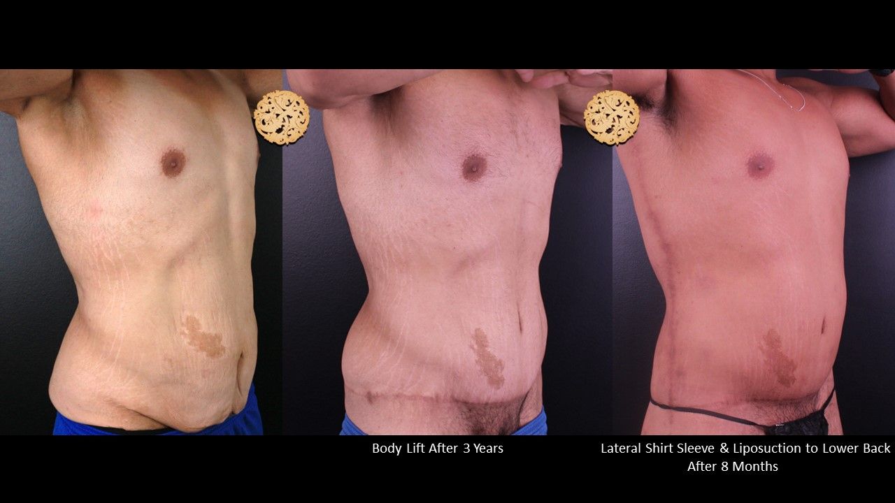 Body Lift Before & After