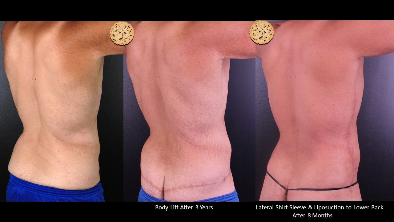 Body Lift Before & After