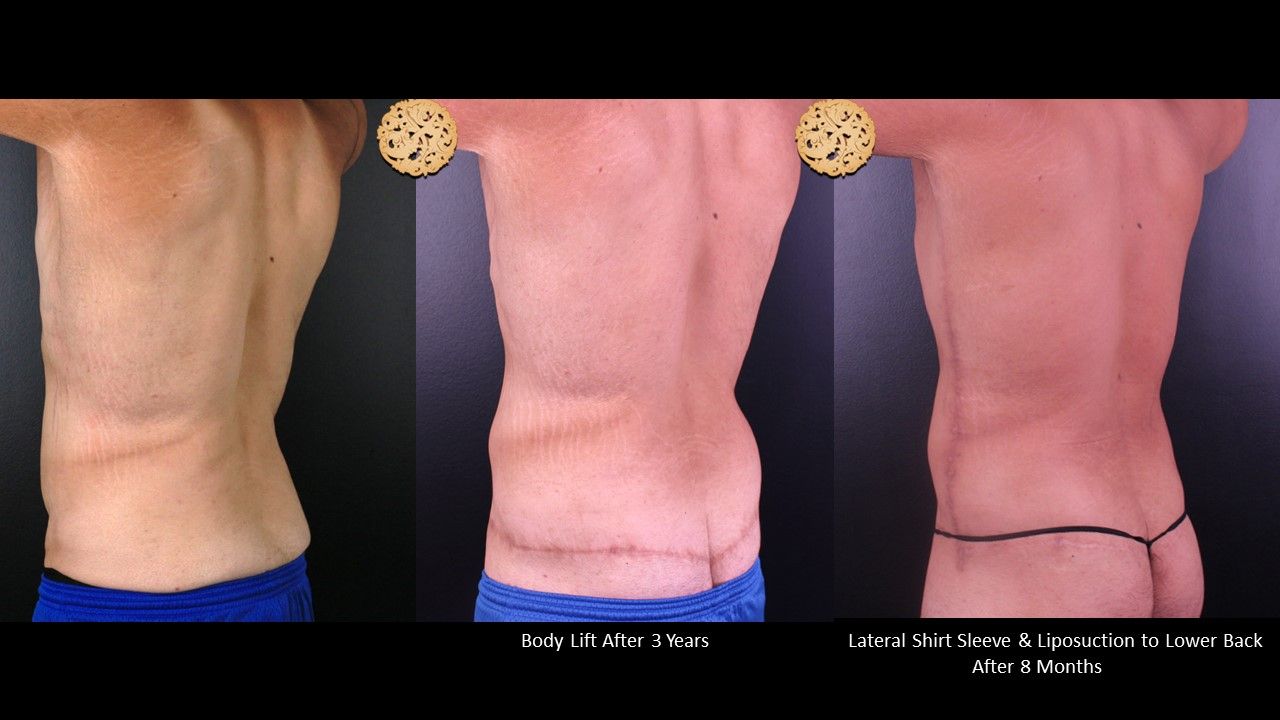 Body Lift Before & After