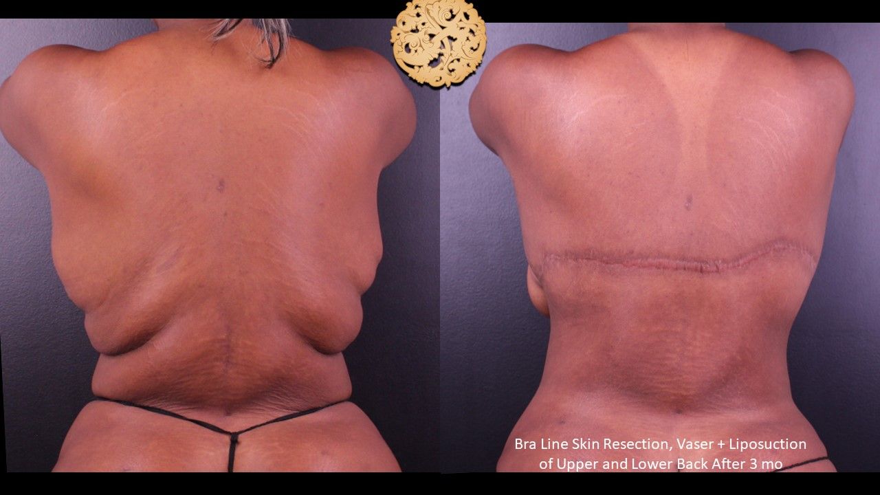 Body Lift Before & After