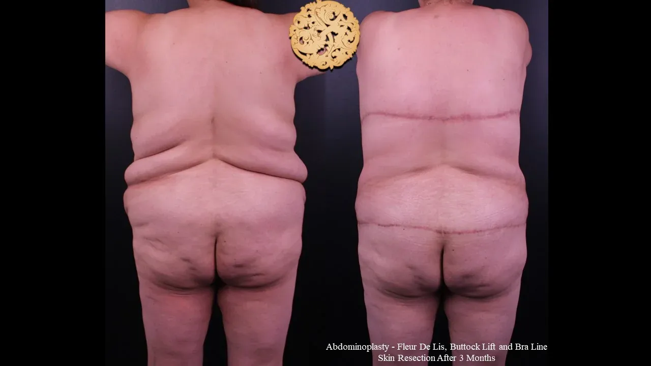 Body Lift Before & After