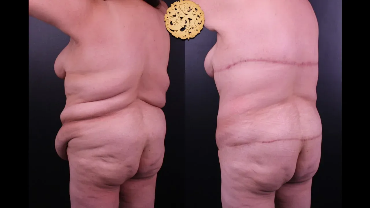Body Lift Before & After