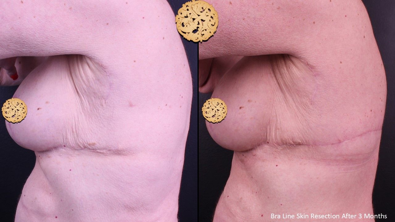 Body Lift Before & After