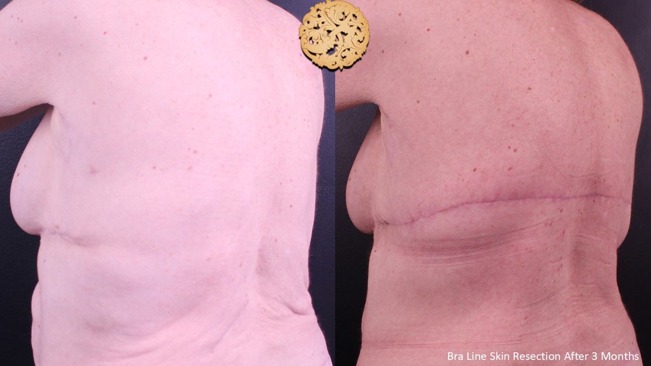 Body Lift Before & After