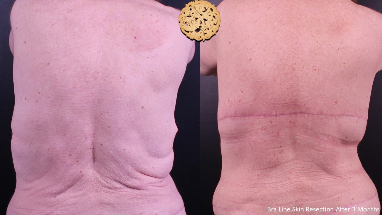 Body Lift Before & After