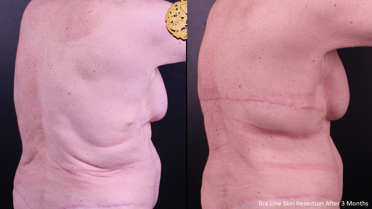 Body Lift Before & After