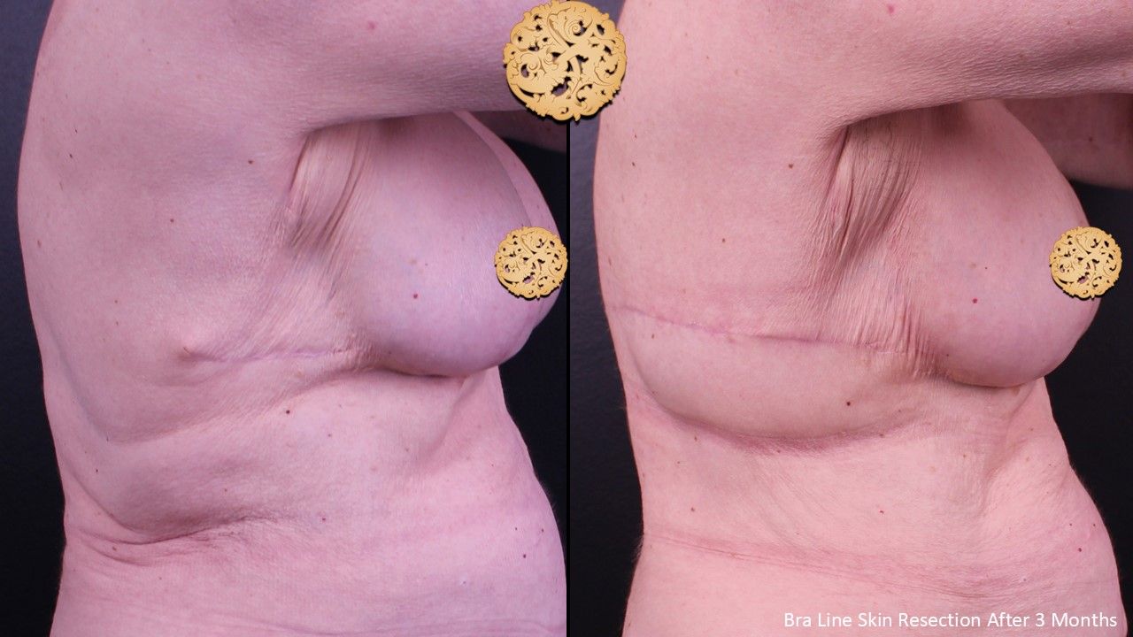 Body Lift Before & After