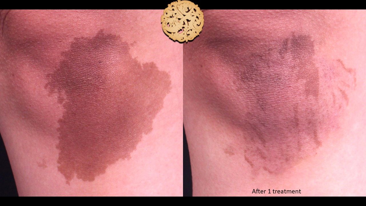 Birthmark Removal Before & After