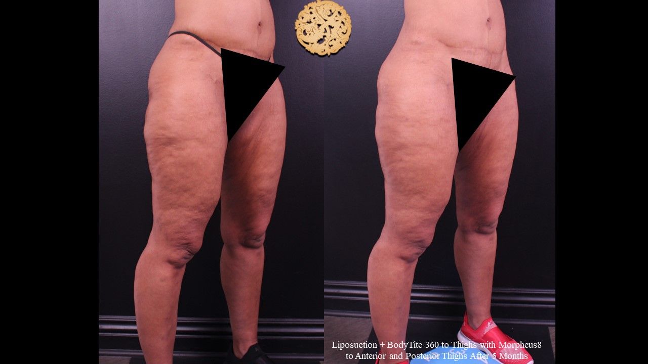 Liposuction Legs Before & After