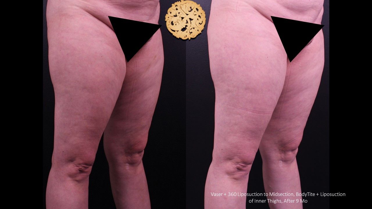Liposuction Legs Before & After
