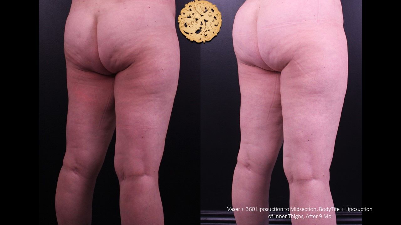 Liposuction Legs Before & After