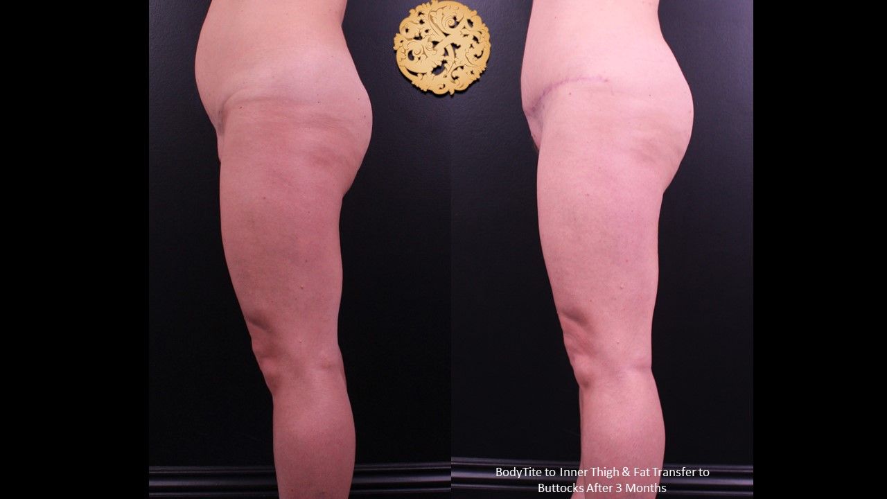 Liposuction Legs Before & After