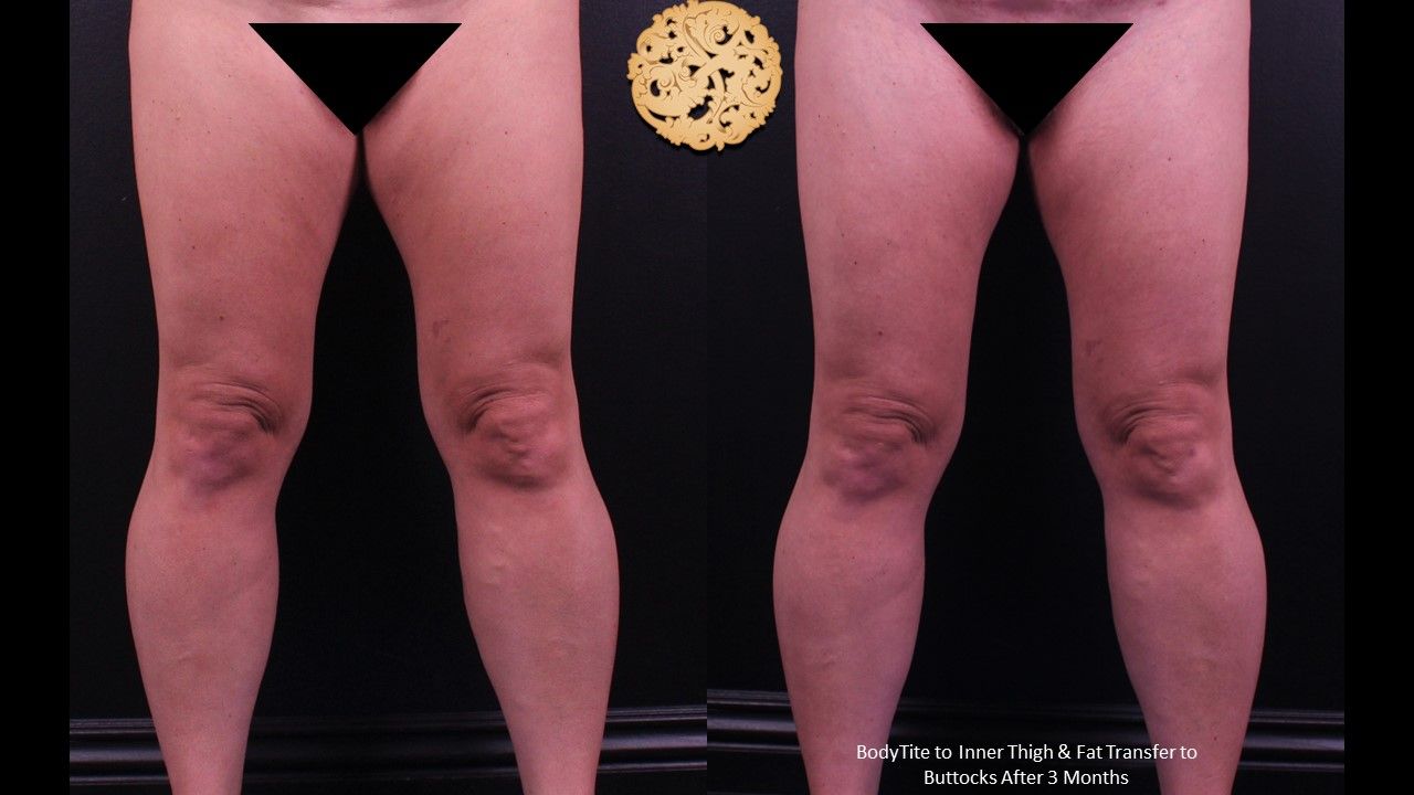 Liposuction Legs Before & After
