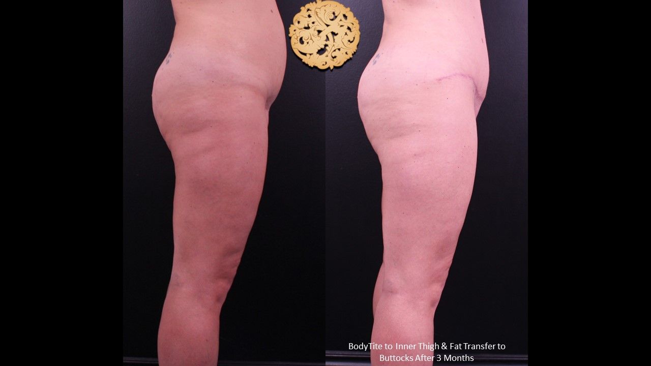 Liposuction Legs Before & After