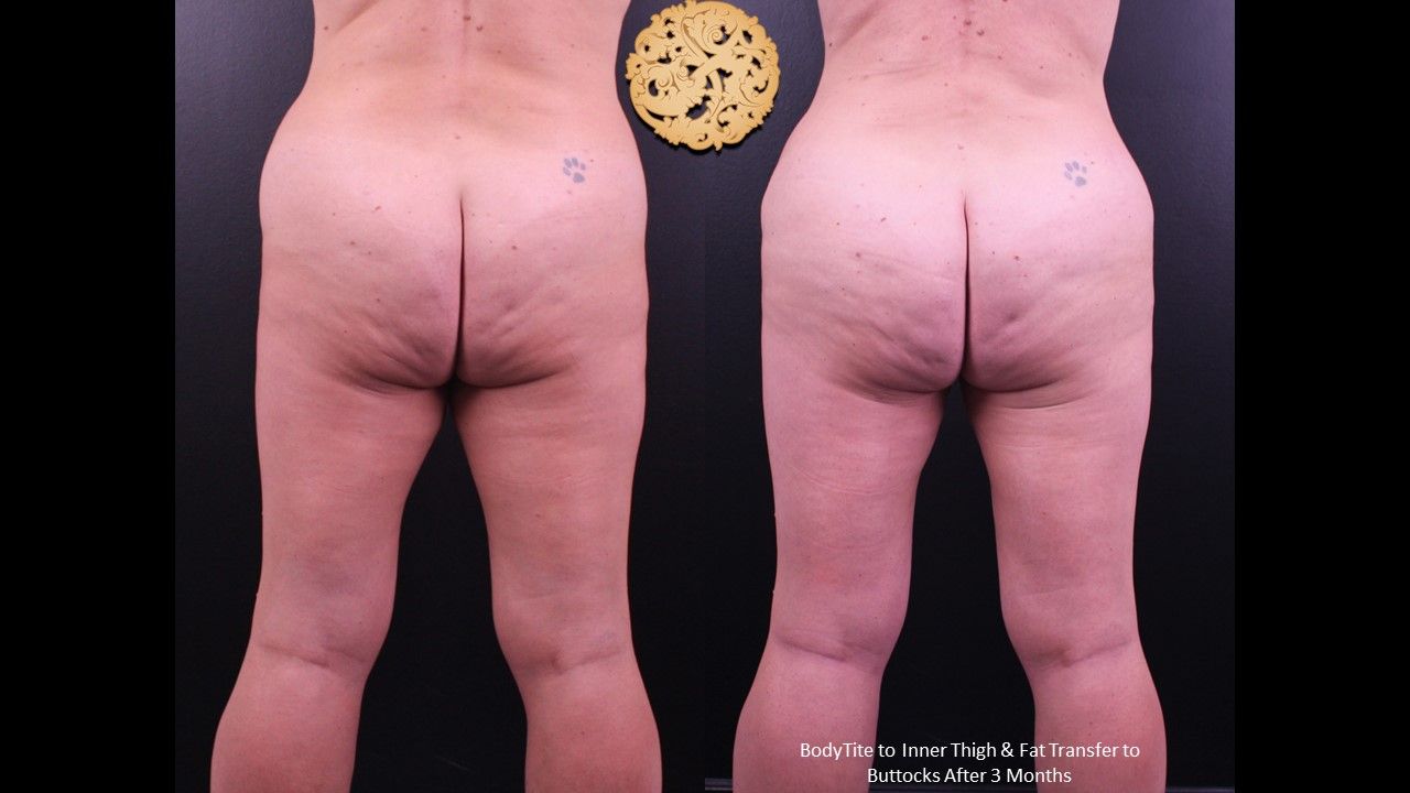 Liposuction Legs Before & After