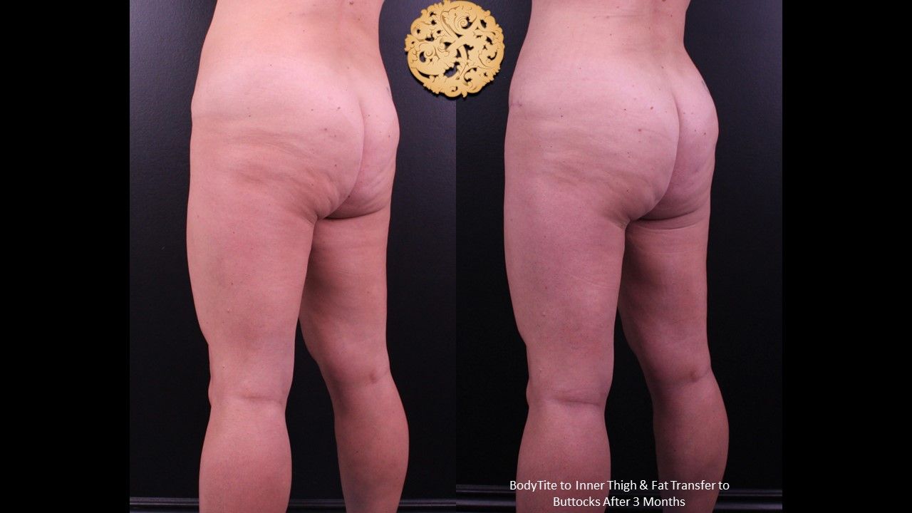 Liposuction Legs Before & After