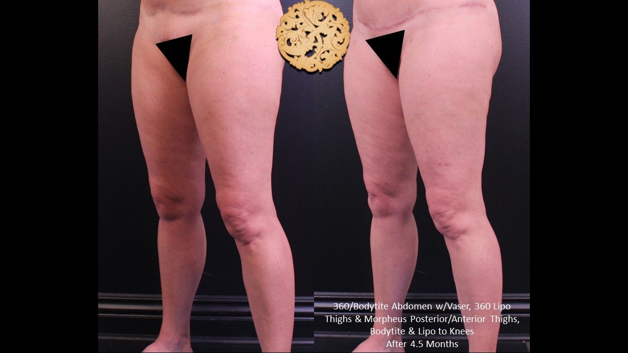 Liposuction Legs Before & After