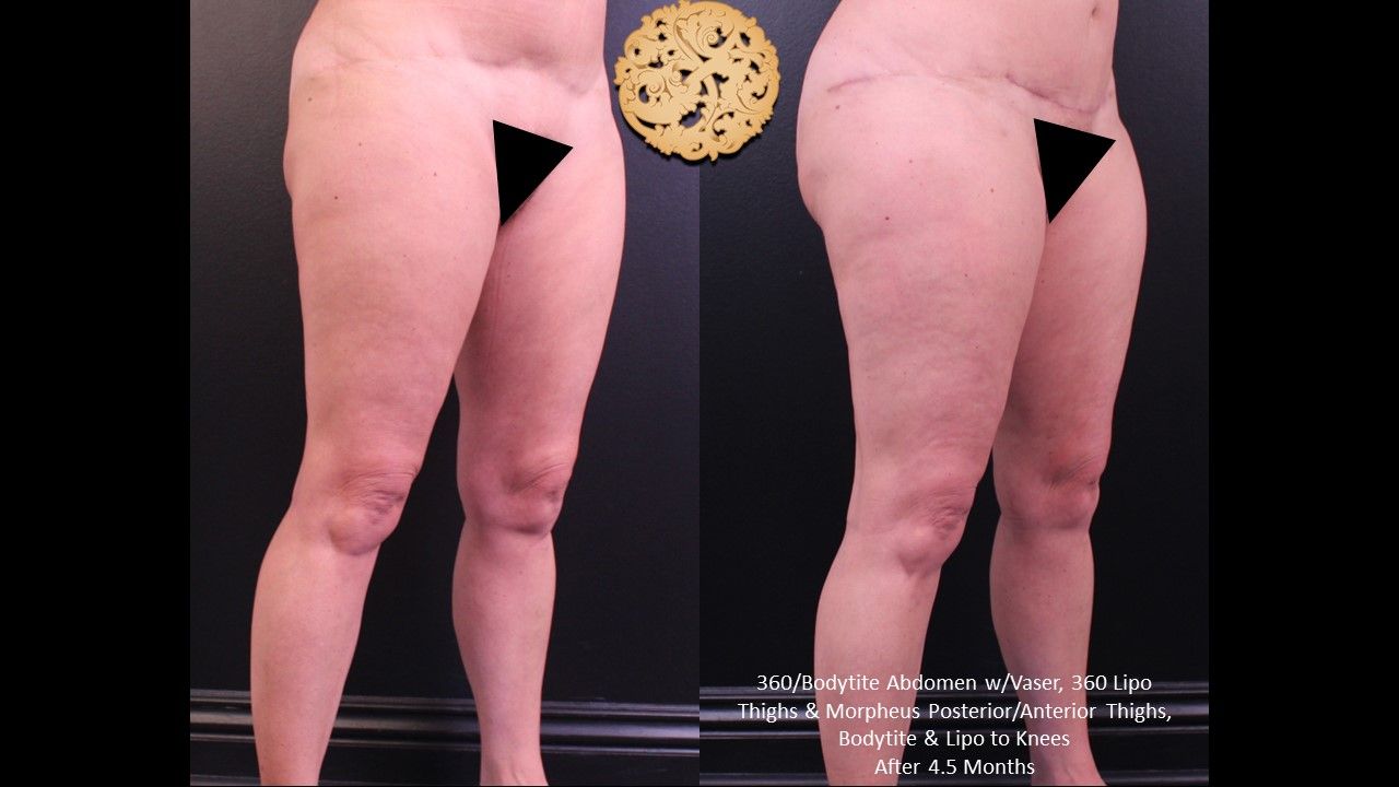 Liposuction Legs Before & After