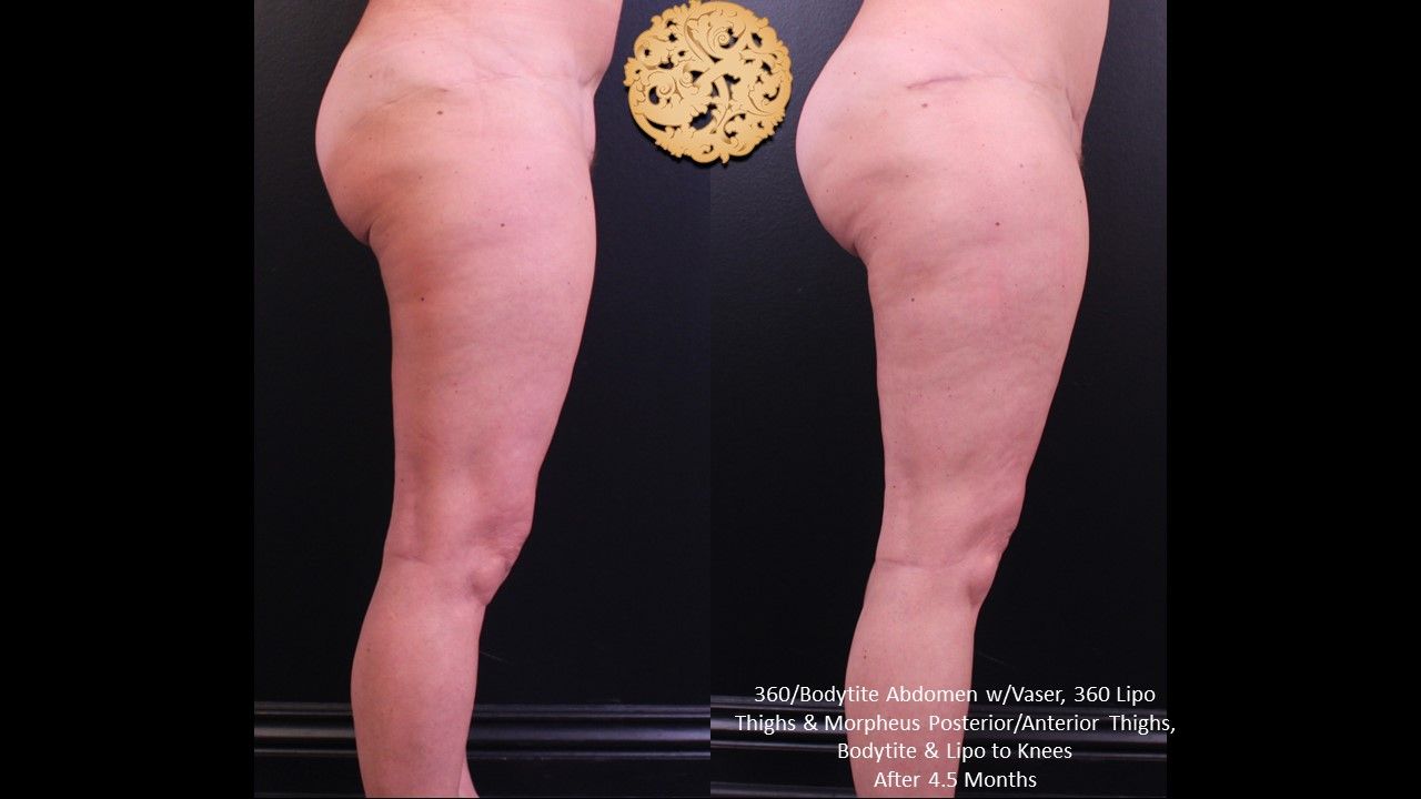 Liposuction Legs Before & After