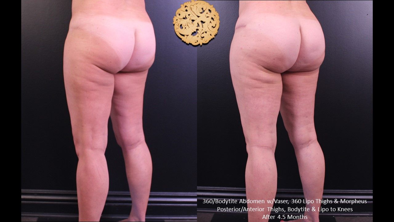 Liposuction Legs Before & After