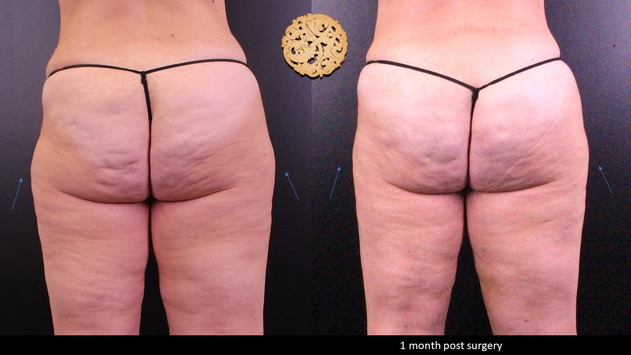 Liposuction Legs Before & After