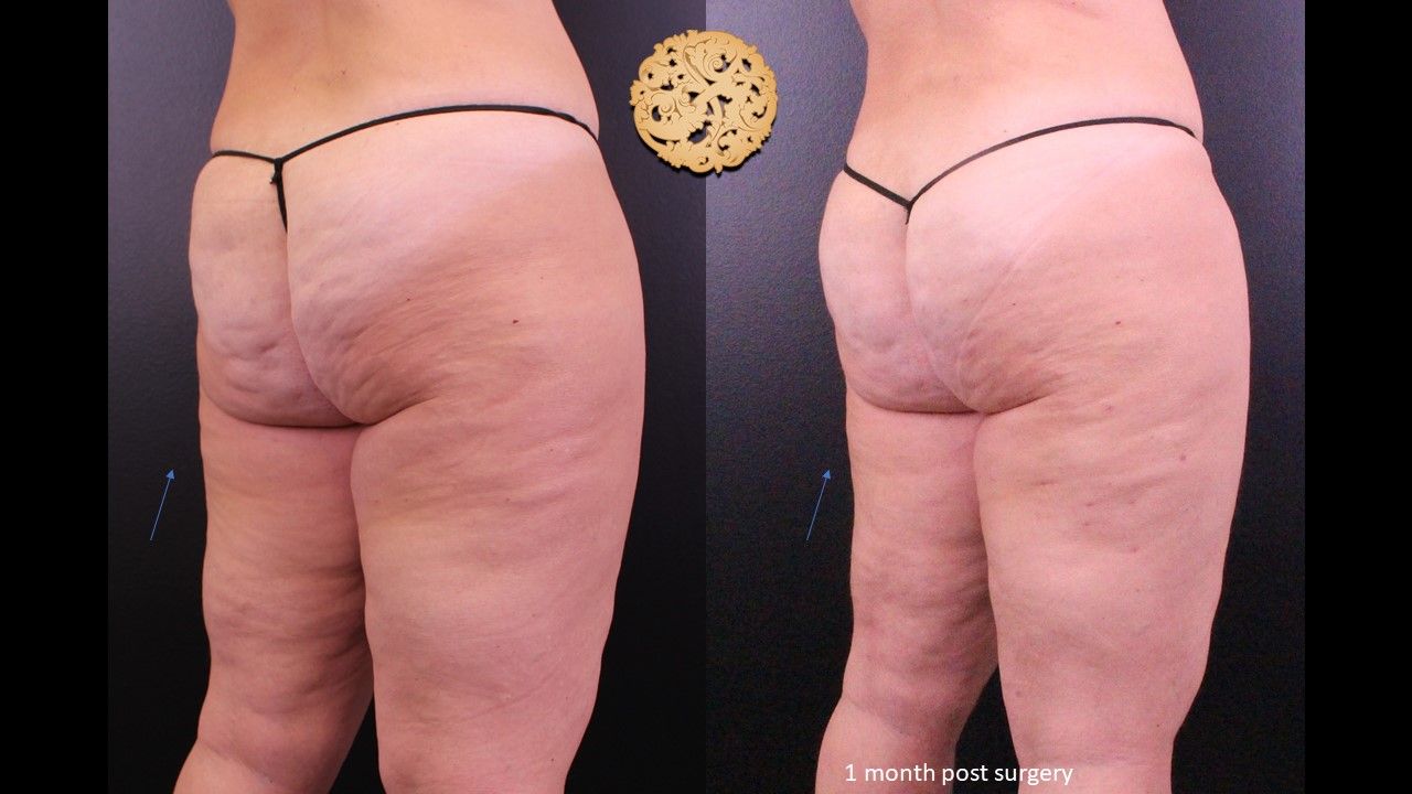 Liposuction Legs Before & After