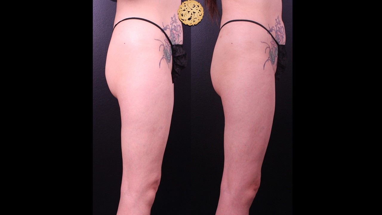 Liposuction Legs Before & After
