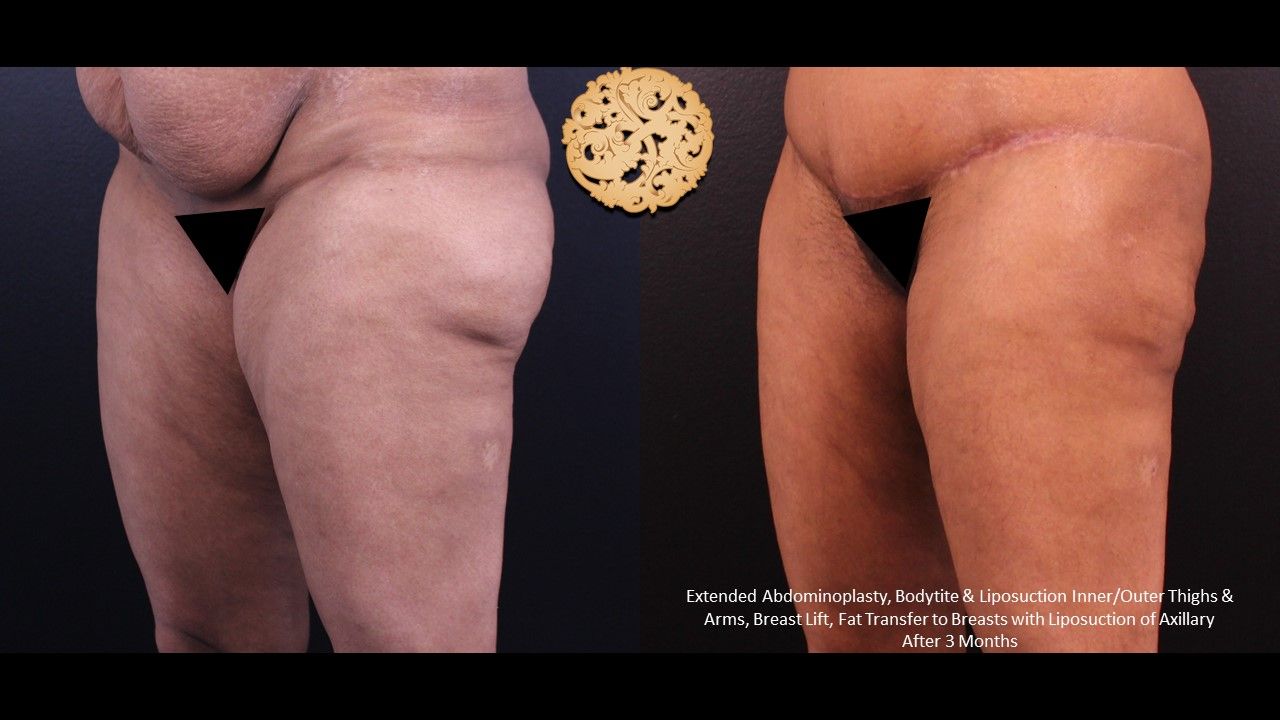 Liposuction Legs Before & After