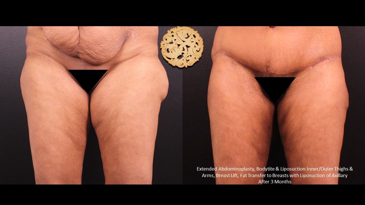 Liposuction Legs Before & After