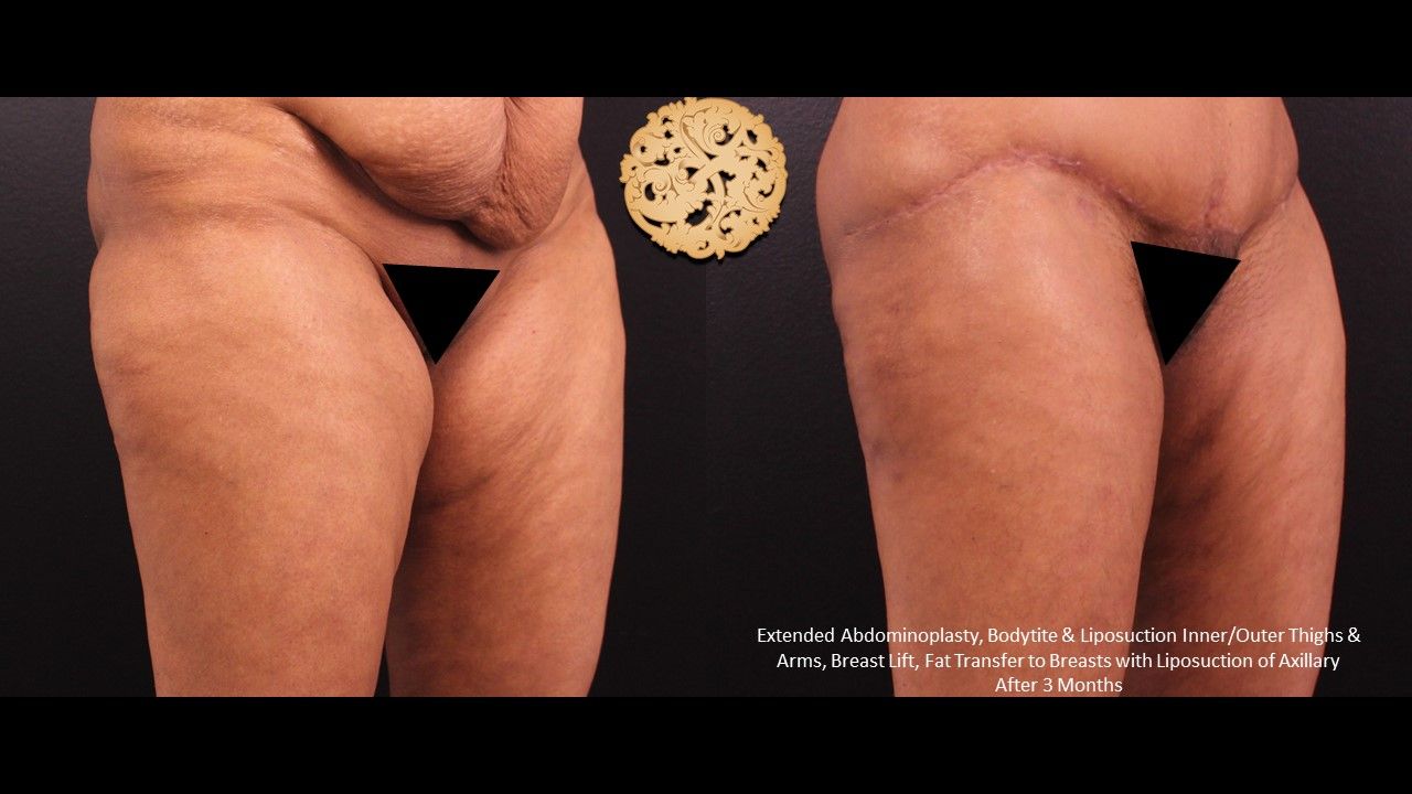 Liposuction Legs Before & After