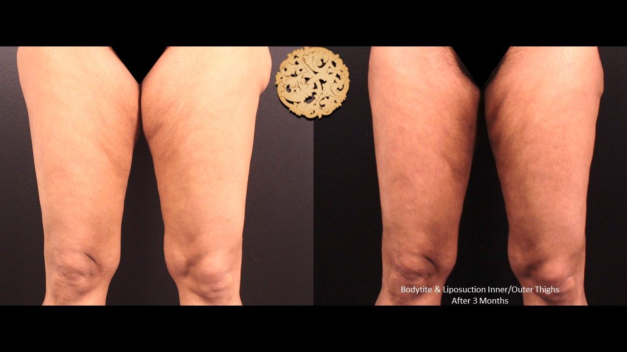Liposuction Legs Before & After