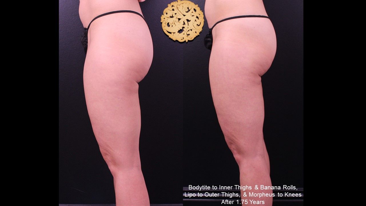 Liposuction Legs Before & After