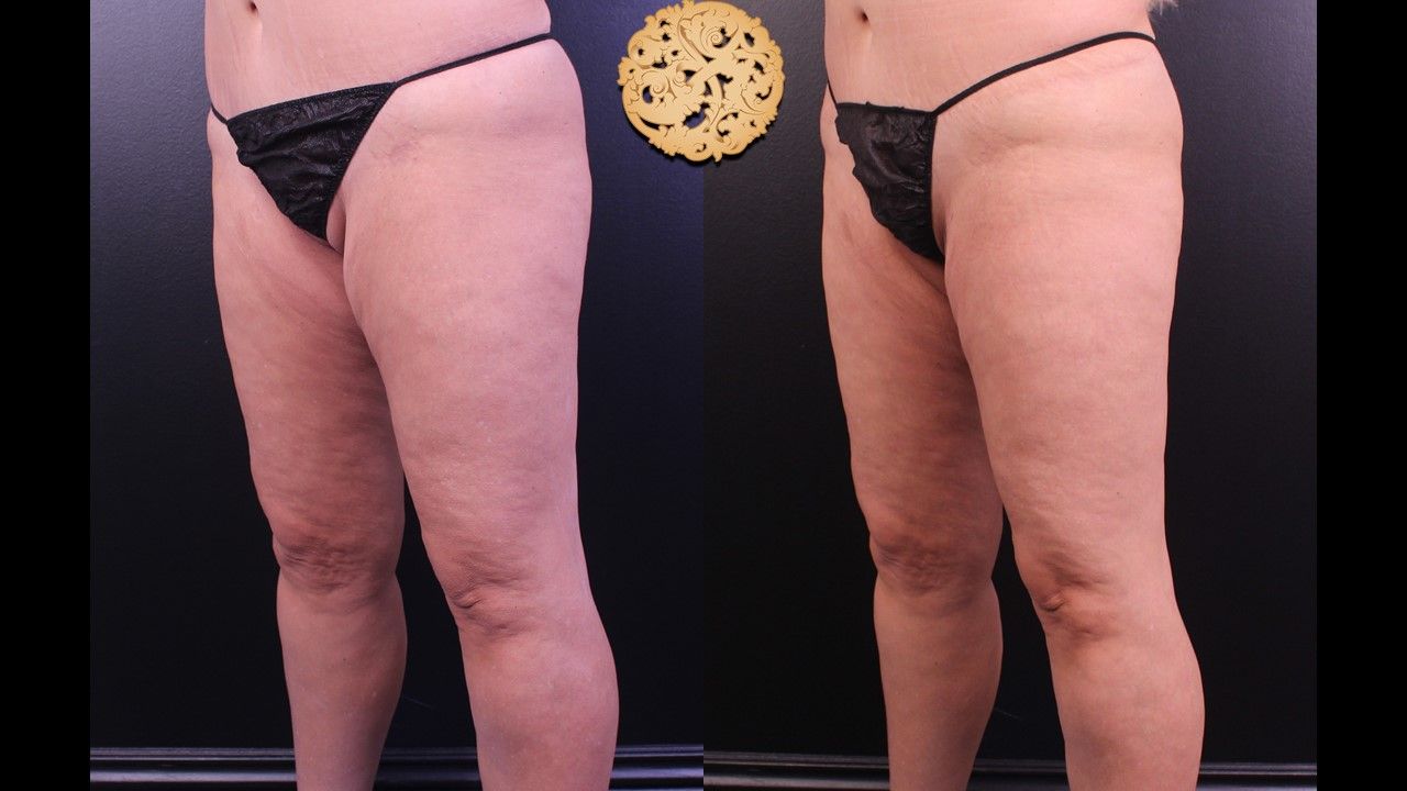 Liposuction Legs Before & After