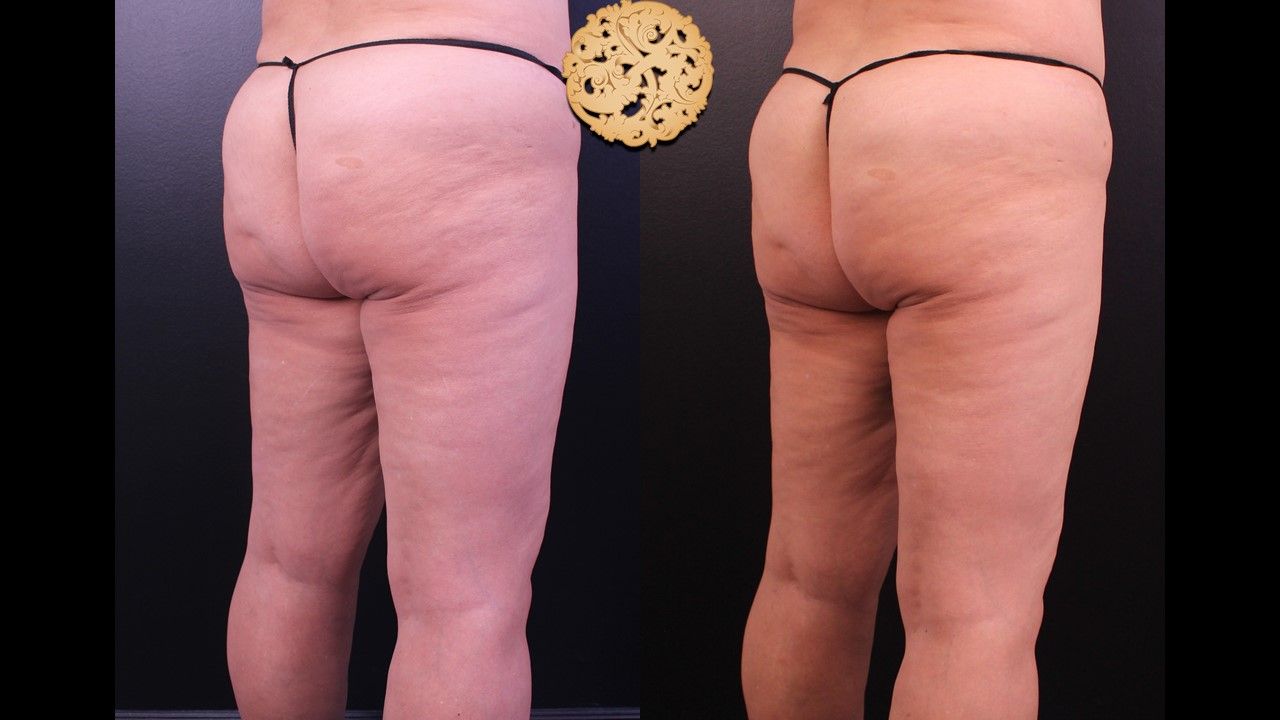 Liposuction Legs Before & After