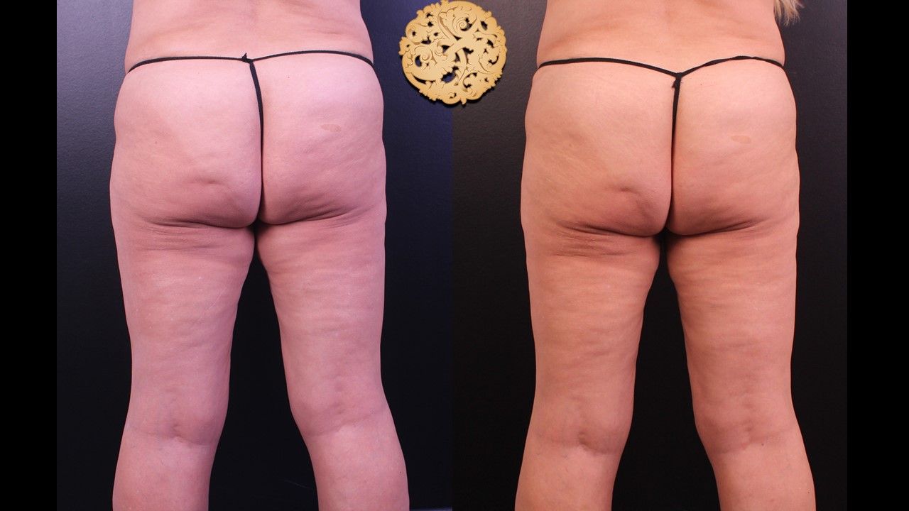 Liposuction Legs Before & After