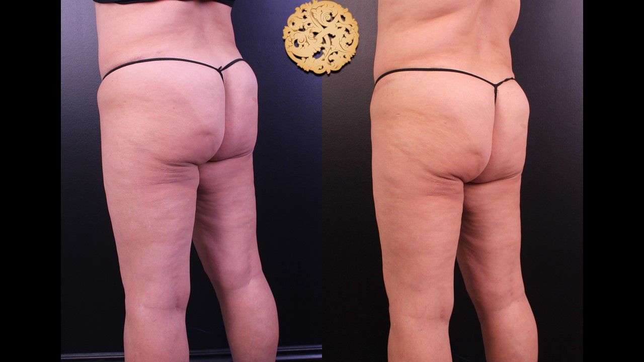 Liposuction Legs Before & After