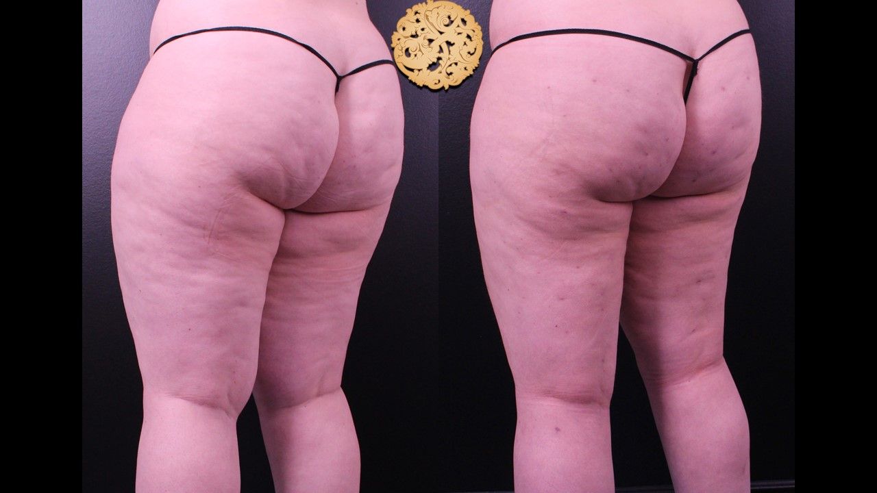 Liposuction Legs Before & After